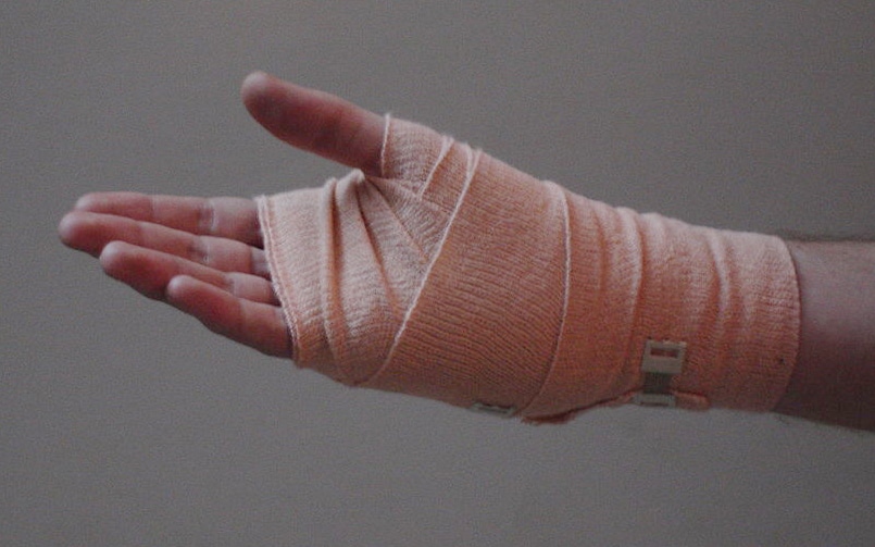 hand with burn injury